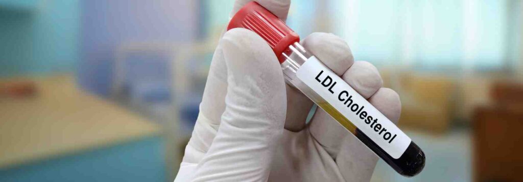 Understand cholesterol with cholesterol profile testing